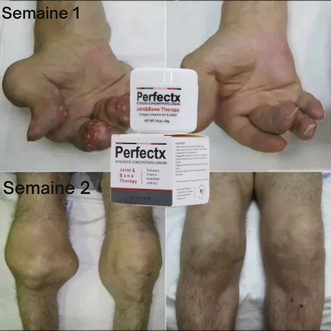 🇬🇳 La Crème  Perfectx Intensive.       L'OPTION N°1 POUR LUTTER CONTRE LES PROBLÈMES ARTICULAIRES ET OSSEUX